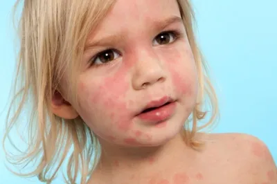 Аллергия на прикорм у ребенка: что делать родителям - Статьи о детском  питании от педиатров и экспертов МАМАКО