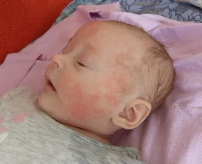 Аллергия на морковь у ребенка фото фото