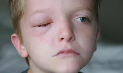 Аллергия у ребёнка — 11 ответов | форум Babyblog