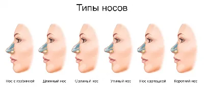 Как исправить нос картошкой: хирургические и неинвазивные методы. Нос \" картошкой\" - методы коррекции