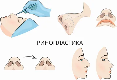 Пластика кончика носа, цена операции по коррекции в Москве