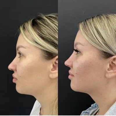 Ринопластика фото до и после, пластика носа результат операции