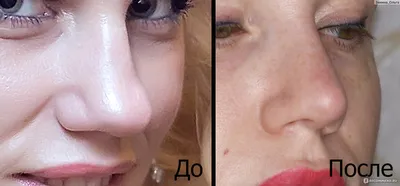 Пластика носа в Нижнем Новгороде | Ринопластика носа