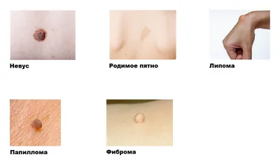 Удаление доброкачественных новообразований кожи - цена в Минске