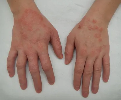 Недостаток кожи Аллергия на кожу Болезнь Уртикарии Красные пятна на коже  Стоковое Фото - изображение насчитывающей убытоки, крапива: 158916112