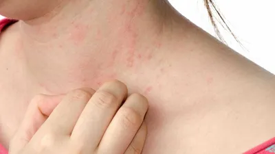 Сыпь на коже аллергия или проблемы с кишечником? | Ирина Ромадова врач  детский проктолог | Дзен