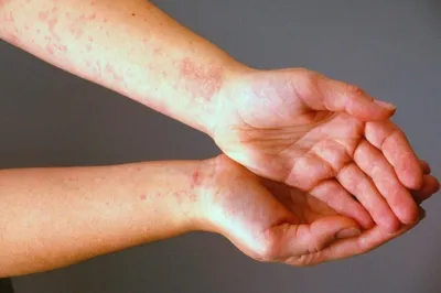Прыщи аллергии на коже ребенка. Пищевая аллергия Стоковое Изображение -  изображение насчитывающей заболевания, зуд: 204332927