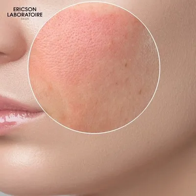 Как аллергия влияет на кожу и что можно сделать, чтобы помочь ей - Лучший  женский журнал
