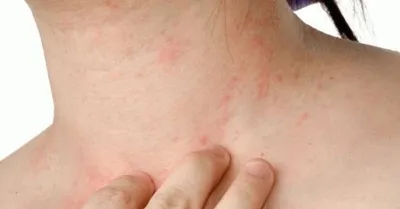 Недостаток кожи Аллергия на кожу Болезнь Уртикарии Красные пятна на коже  Стоковое Фото - изображение насчитывающей аллергически, раздражано:  158916508