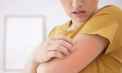 Аллергия на коже: как с этим справиться / Всё о нашей коже Teana Labs