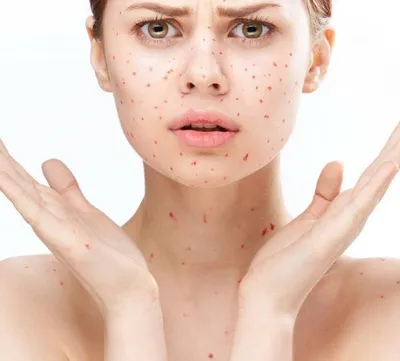 Мазь Астеллас Фарма Протопик - «Пищевая аллергия на лице. Как избавиться от  красных пятен за 1 неделю.» | отзывы