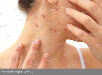 Может ли аллергия на порошок проявляться только покраснением на лице? — 13  ответов | форум Babyblog