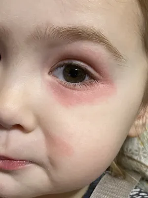 Аллергия у детей - Как лечить аллергию у детей?
