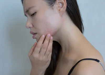 Аллергия на маску для лица - YouTube