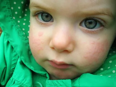 Аллергия на лице — 2 ответов | форум Babyblog