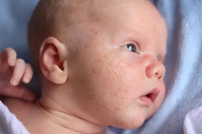 Аллергическая сыпь на лице: почему может появиться аллергия на лице, как  избавиться | блог Expert Clinics