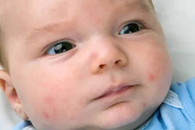 Как защитить младенца от аллергии: правила и советы | Все о звездах и не  только | Дзен