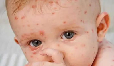 Что делать, если появилась аллергия на лице | Женский журнал Korolcat.ru |  Дзен