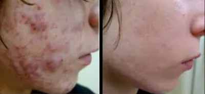 Демодекоз у человека на лице: причины, лечение