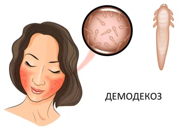 Демодекс на лице: в чем коварство болезни, как от нее избавиться