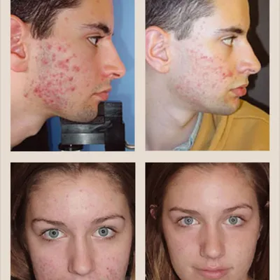 Демодекоз на лице: как выглядят высыпания | DermaQuest | Дзен