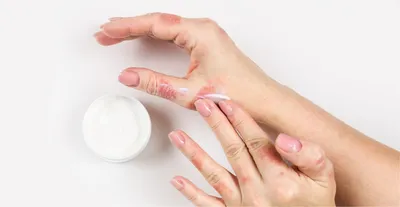 Экзема на руках — это заболевание кожи, которое порой может привести к  сильному дискомфорту и боли. Тем не менее, существуют ряд мер… | Instagram