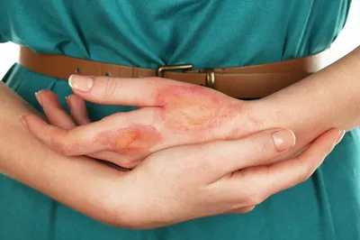 закрытие руки женщины. дерматит или экзема на руках Стоковое Фото -  изображение насчитывающей зудяще, внимательность: 216444378