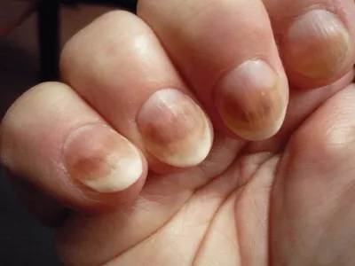 Экзема на руках Женские руки, пострадавшие от дерматита Закрыть Стоковое  Фото - изображение насчитывающей гигиена, зудяще: 163055992