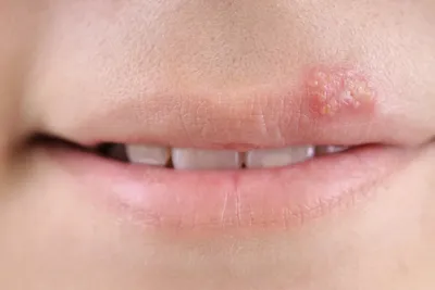 Сальные железы на половых губах у женщин - YouTube