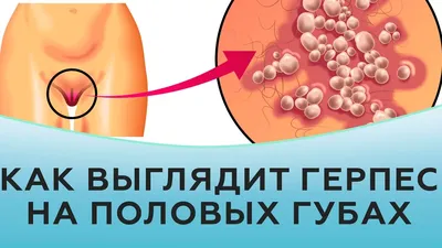 Генитальный герпес на половых органах у мужчин и женщин, лечение, симптомы
