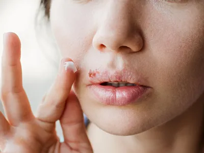 Взорвать женских половых губ, страдающих от герпеса. Герпес губ зараженную  вирусом Стоковое Фото - изображение насчитывающей сторона, условие:  178223324