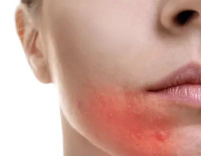 Чем лечить герпес на губах: быстрое лечение | Doc.ua