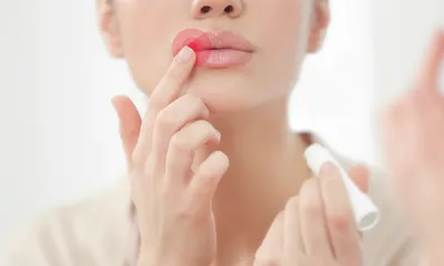 Герпес на губах (простуда): чем лечить, причины, симптомы и как быстро  избавиться