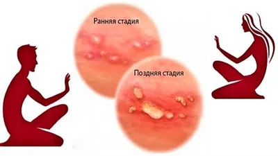 Вирусы герпеса: типы, симптомы, диагностика и лечение