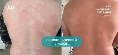 Розовый лишай: причины, симптомы, терапия - MedicalAdvice.ru