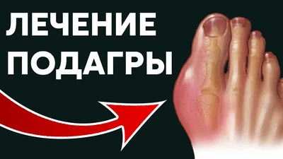 Лечение подагры (подагрического артрита) в Омске | цены на услуги врача в  клинике Центр EzraMed Clinic