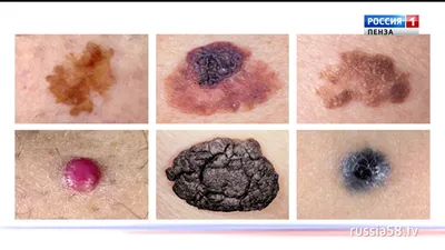 Базалиома (базальноклеточный рак кожи): симптомы, стадии, прогнозы,  классификация, методы диагностики и лечения