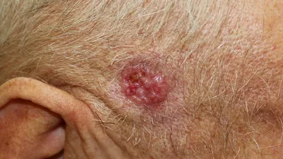 Назван способ определить рак легких по состоянию кожи: Аномалии: Из жизни:  Lenta.ru