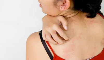 Аллергическая Сыпь На Теле Больного 5летняя Девочка Вызван Реакцией На  Антибиотики — стоковые фотографии и другие картинки Аллергия - iStock