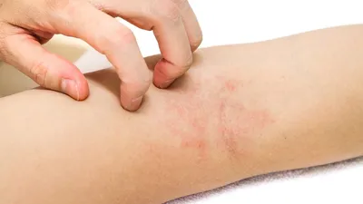 Аллергическая сыпь на теле пациента . стоковое фото ©vershinin.photo  362308540