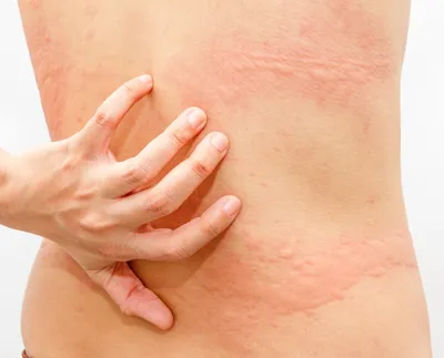 Как лечить сыпь на коже после Ковид-19 | Солнышко