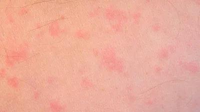 аллергическая сыпь на теле 5-летней девочки. Стоковое Фото - изображение  насчитывающей аллергически, медицинско: 228931306