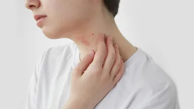 Учёные: Фастфуд способствует развитию аллергии у детей