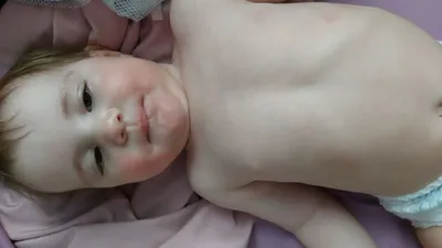 Аллергия на хрустящую морковь довольно редка. Но вот если у вас  присутствует аллергия на березовую пыльцу - стоит опасаться перекрест… |  Морковь, Аллергия, Лечение