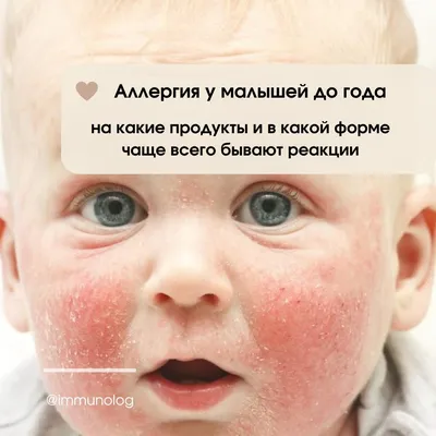 5 советов родителям аллергика - KP.RU
