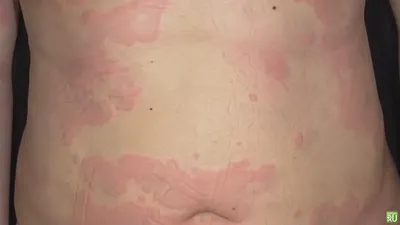 Сверхчувствительность на томаты