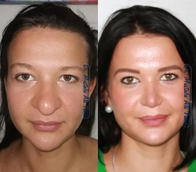 Выше нос: как укорачивающая ринопластика меняет лицо (10 женщин до и после)  | BonaModa | Дзен