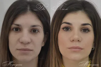 Ринопластика носа картошкой в Москве - цены, отзывы, реальные фото до и  после | Александр Маркушин пластический хирург