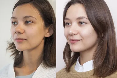 Результат ринопластики три месяца спустя | Beauty Insider