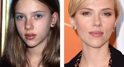 Ринопластика до и после: фото и отзывы | Beauty Insider